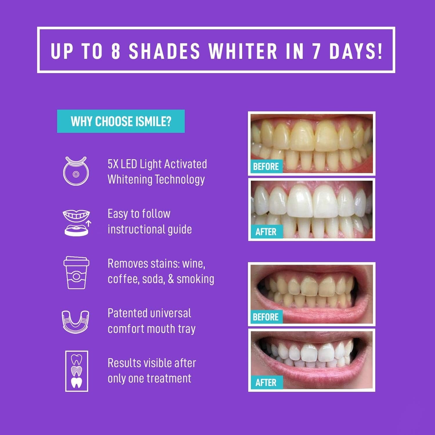 iSmile Teeth Whitening Kit - LED Light